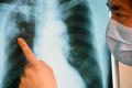 Что такое туберкулез и как им можно заразиться?