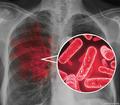 Что необходимо знать о туберкулезе?